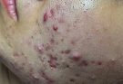 Inflammatory acne, yellow acne, blackheads - Acne Treatments Mai Ngoc 💕💕💕