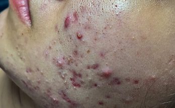 Inflammatory acne, yellow acne, blackheads - Acne Treatments Mai Ngoc 💕💕💕