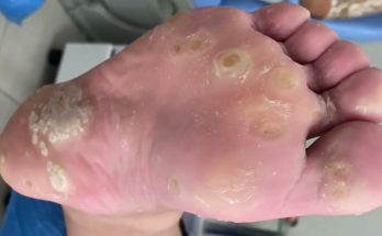 Warts remove calluses