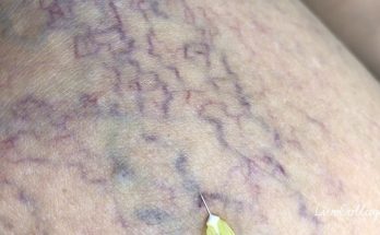 Micro sclerotherapy for spider veins