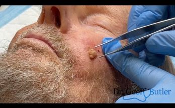 Removal of a Basal Cell Cancer on the face