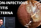 Non-Infectious Otitis Externa Underneath Dead Skin Plug (Acetic Acid Discussed)