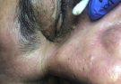 Old Eye Blackheads