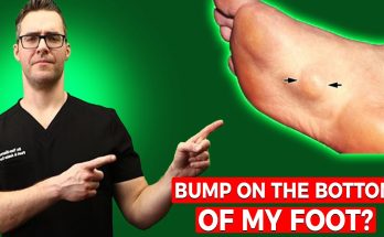 Bump on the Bottom of My Foot? [Plantar Fibroma Treatment & Massage!]