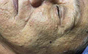 Blackheads Removal at CA ROT