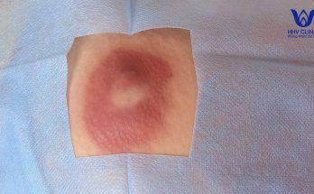 Squeezing abscesses (buttocks)