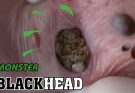 Monster Blackhead Removal | Acne Treatment