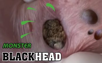 Monster Blackhead Removal | Acne Treatment