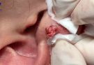 TREATMENT OF BOILERS (EAR ABSCESS) AT HHV CLINIC DERMATOLOGY CLINIC.