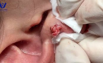 TREATMENT OF BOILERS (EAR ABSCESS) AT HHV CLINIC DERMATOLOGY CLINIC.