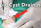 Draining a Pilonidal Cyst on the Gluteal Cleft - Max Poling PA-C