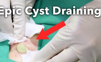 Draining a Pilonidal Cyst on the Gluteal Cleft - Max Poling PA-C