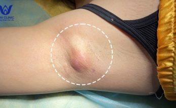 Squeezing armpit abscess - Guaranteed effectiveness after 1 treatment - Acne does not recur.