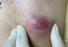 Squeezing armpit abscess - Guaranteed effective and no recurrence.