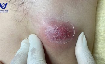 Squeezing armpit abscess - Guaranteed effective and no recurrence.