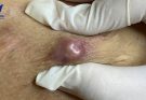 Squeezing abscess (butt crack area)