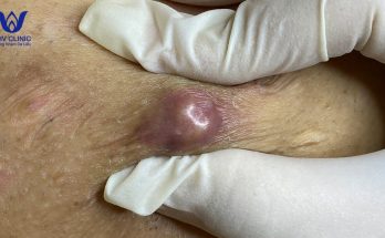 Squeezing abscess (butt crack area)