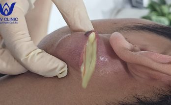 Cystic acne treatment at HHV Clinic