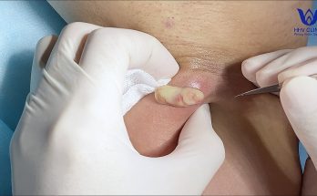 (video inside) Squeezing abscesses (armpit area) - Guaranteed effectiveness after 1 treatment - Acne does not recur.