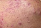 OMG Teen moments Remove BLACKHEADS