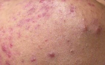 OMG Teen moments Remove BLACKHEADS