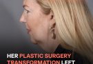 A Woman Underwent Plastic Surgery and Left Everyone Perplexed: 11 Inspiring Before-and-After Stories