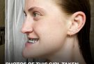 This Girl Underwent Double Jaw Surgery — Before-and-After Photos Left Everyone Speechless