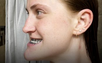 This Girl Underwent Double Jaw Surgery — Before-and-After Photos Left Everyone Speechless