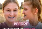 This Girl Underwent Double Jaw Surgery — Before-and-After Photos Left Everyone Speechless