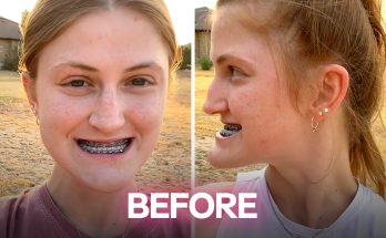 This Girl Underwent Double Jaw Surgery — Before-and-After Photos Left Everyone Speechless