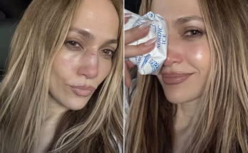Jennifer Lopez Ices Painful-Looking Facial Wound Sustained During AMA Rehearsals: 'So, This Happened'
