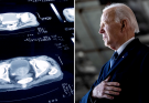 Gleason score for prostate cancer: What to know about Biden's diagnosis