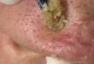 Blackheads on the nose, like lovely pearls