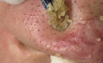 Blackheads on the nose, like lovely pearls