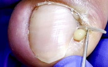 Lots Of Pus Coming Out! ! Nails Crazily Embedded