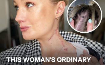 A 29-Year-Old Woman Saw Doctors About a Mole, but They Dismissed It – Later She Learned She Had Aggressive Skin Cancer