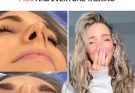This Girl Couldn't Breathe Through One Nostril and After 2 Surgeries, Her Nose Lost Its Original Shape – Photos