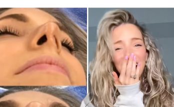 This Girl Couldn't Breathe Through One Nostril and After 2 Surgeries, Her Nose Lost Its Original Shape – Photos