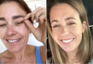 Woman Gets Popular Upper Bleph Plastic Surgery for Sagging Eyelids. Her Husband's Reaction Is Priceless