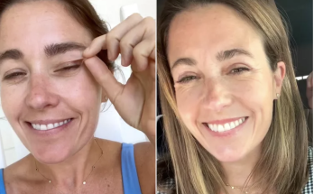 Woman Gets Popular Upper Bleph Plastic Surgery for Sagging Eyelids. Her Husband's Reaction Is Priceless